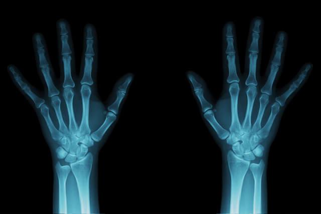 Imaging of hand bones
