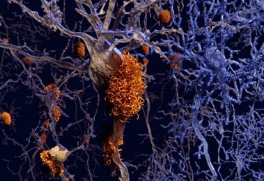 受阿尔茨海默病斑块影响的神经元图