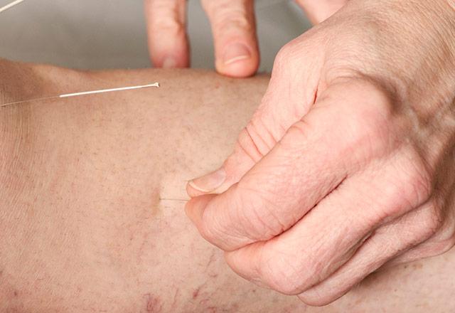 Acupuncture needle inserted into a shoulder