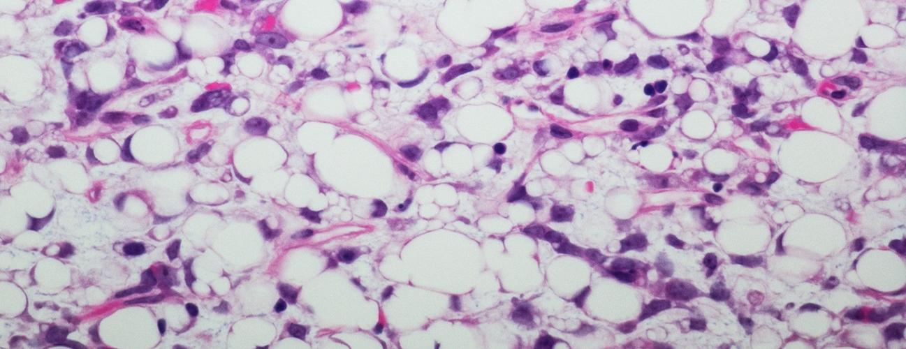 liposarcoma cells under a microscope