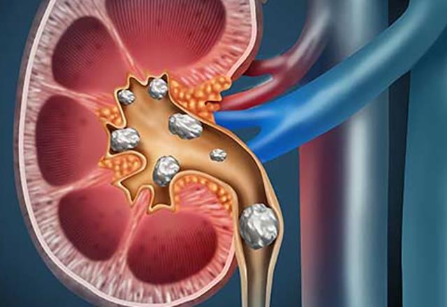 johns hopkins surgery - illustration of diseased kidney