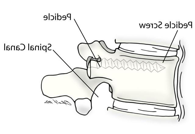 Illustration showing the pedicle screw through the pedicle