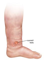 Illustration of a venous ulcer