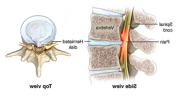 说明椎间盘突出如何对脊髓施加压力，导致脊髓病