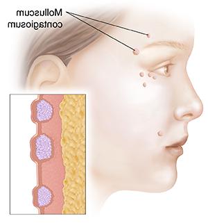 Side view of woman's face showing molluscum contagiosum. Inset shows cross section of molluscum contagiosum.