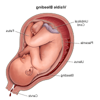 插图显示怀孕期间明显出血